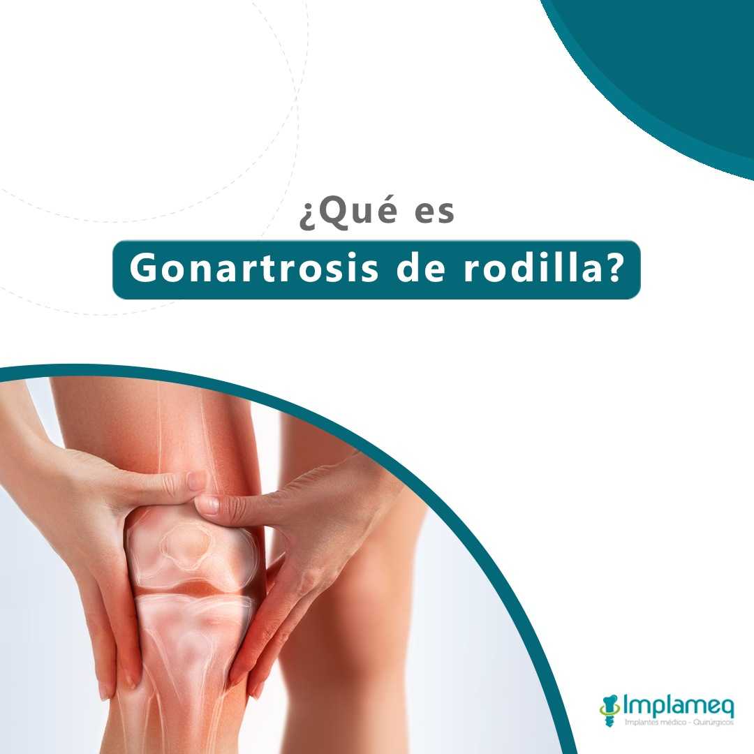 ¿Qué es la gonartrosis?